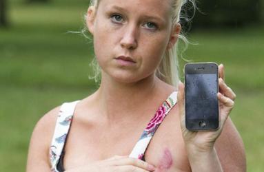 Dionne Baxter, una joven británica de 24 años, sufrió este fin de semana una severa quemadura en su pecho. Foto: Especial