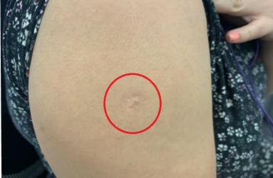 ¿Por qué los mexicanos tenemos esta cicatriz en el brazo?. Foto: iStock
