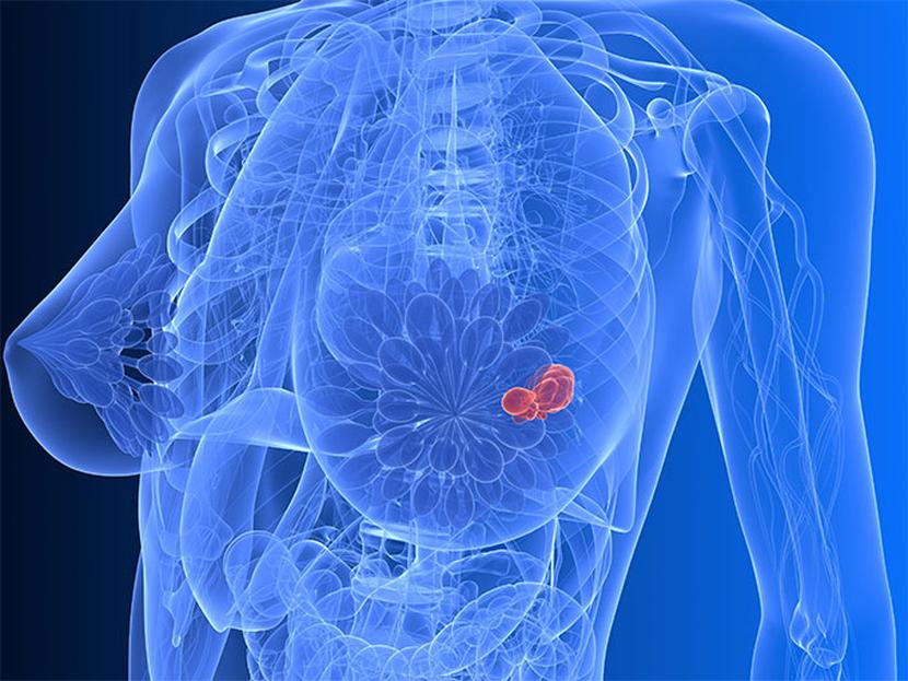 Cada año se diagnostican entre 18 mil y 20 mil casos de cáncer de mama, de los cuales cada día mueren en promedio 15 mujeres. Foto: Archivo