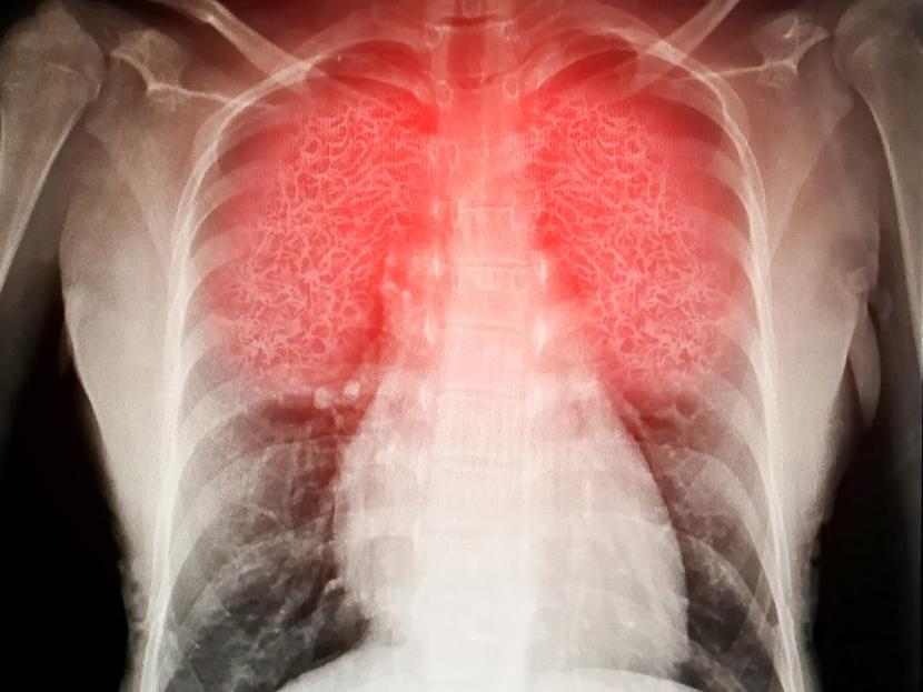 El 80% de los pacientes entre 17 y 87 años, presentaron por lo menos uno de los síntomas a nivel pulmonar. Foto: iStock